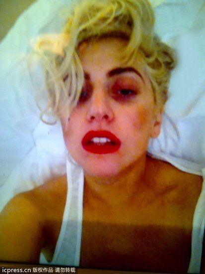 Lady Gaga被伴舞击中导致脑震荡 自拍报平安